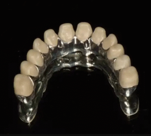 cobalt chrome prosthetic framework with PFM teeth