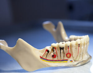 root canal treatment model