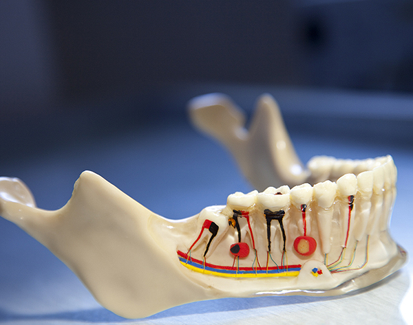 root canal treatment model
