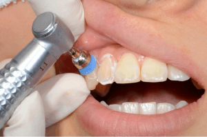 cleaning scalar teeth in dentistry