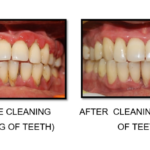 How harmful is tooth scaling to the teeth?