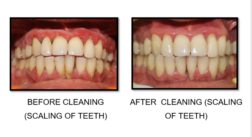 How harmful is tooth scaling to the teeth?
