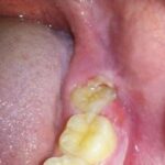 Why is the position of the wisdom teeth so painful?