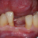How to choose a filling if the front tooth is missing? How much do dental fillings cost?