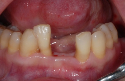 Why do my teeth still hurt when there is no tooth decay, and my gums bleed even when I brush my teeth?