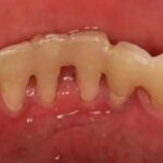 Why do I get periodontitis? How to adjust?