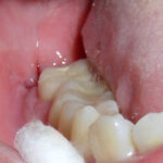 How do I keep the cavity clean after my wisdom tooth is extracted?