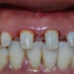 What should I do if the abutment of the porcelain tooth is rotted? Is the porcelain tooth material affected?
