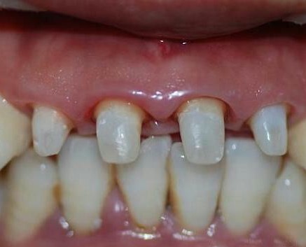What should I do if the abutment of the porcelain tooth is rotted? Is the porcelain tooth material affected?