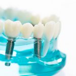 Ultimate Guide to Dental Implants