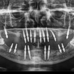 Unveiling the Precision of Digital X-Rays in Modern Dentistry