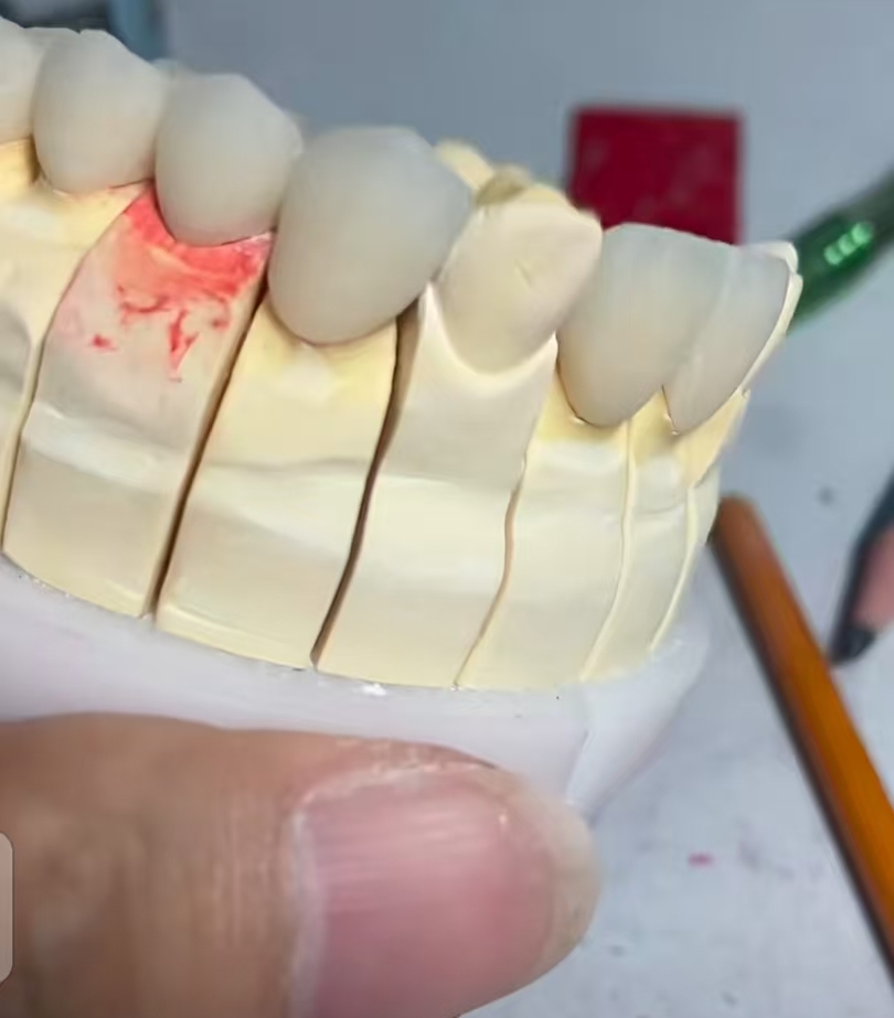 die stone model fabricated by pindex and laser saw cutting system